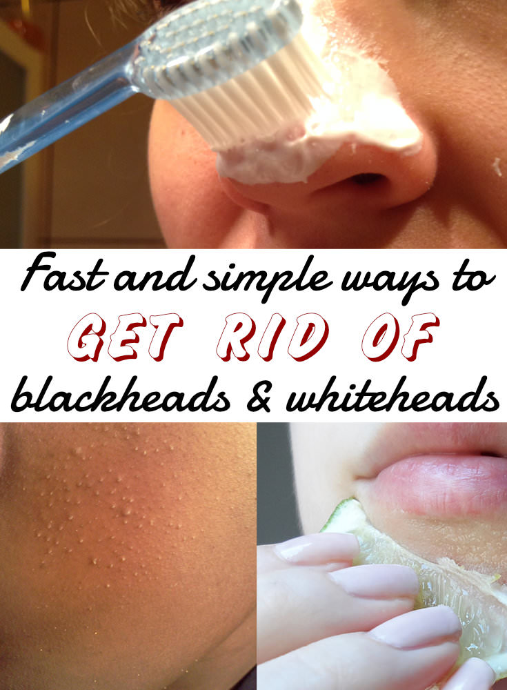 Blackheads or whiteheads are one of the peskiest problems instead of using chemical products to remove them there are many home remedies available. Check out!